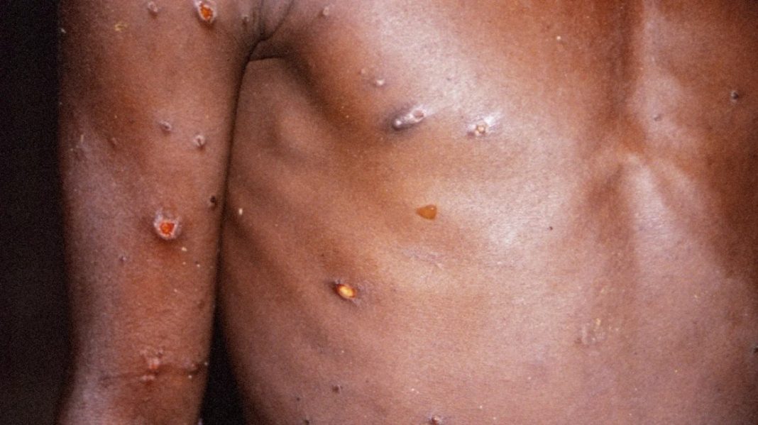 KISUMU COUNTY CONFIRMS FIRST CASE OF MPOX, ISSUES PUBLIC HEALTH ALERT KISUMU COUNTY CONFIRMS FIRST CASE OF MPOX, ISSUES PUBLIC HEALTH ALERT